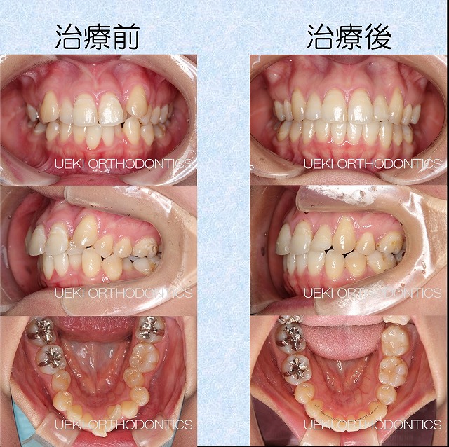 うえき矯正歯科 岡山市の矯正歯科