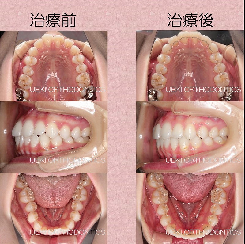 うえき矯正歯科 岡山市の矯正歯科