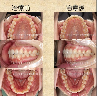 うえき矯正歯科 岡山市の矯正歯科