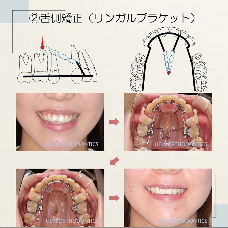 うえき矯正歯科 岡山市の矯正歯科