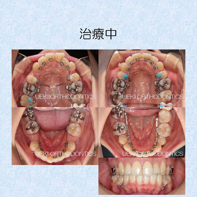 うえき矯正歯科 岡山市の矯正歯科
