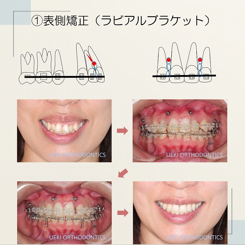 アンカースクリューを用いたガミースマイル治療 | ブログ | うえき矯正歯科 岡山市の矯正歯科